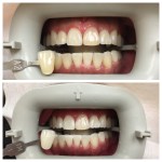 before and after teeth whitening
