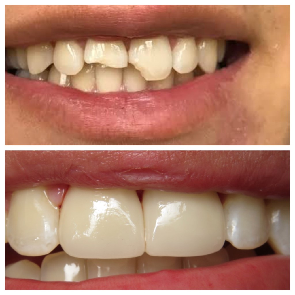 broken teeth before and after