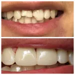 broken teeth before and after