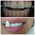 teeth whitening before and after